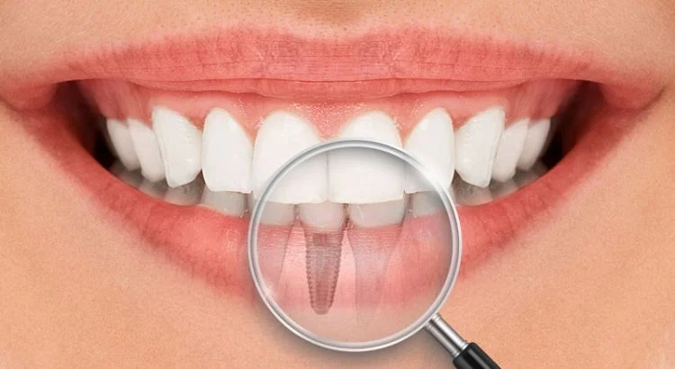 Imagem ilustrativa de um implante dentário de titânio.