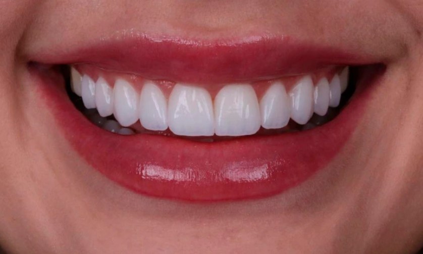 Sorriso perfeito com lentes de contato dental de porcelana